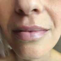 Po zákroku - 0,7ml Filler (Princess)