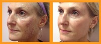 Fillerlike kuur, in combinatie met Botoxlike behandelingen en aangevuld met LEDtherapie