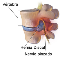 Hernia discal posterior