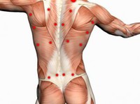 Triggerpointtherapie