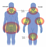 Massage bij fybromyalgie