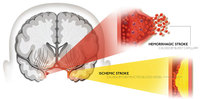 Obat stroke ringan