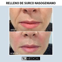 Surco Nasogeniano