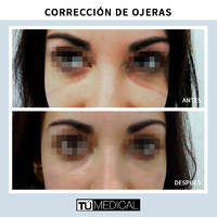 Ojeras