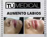 Resultados de Aumento de Labios con Ácido Hialurónico